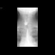 Zenker's diverticulum of the oesophagus: RF - Fluoroscopy